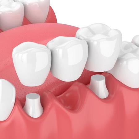 dental crowns and bridges in Guntur