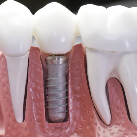 dental implants in Guntur