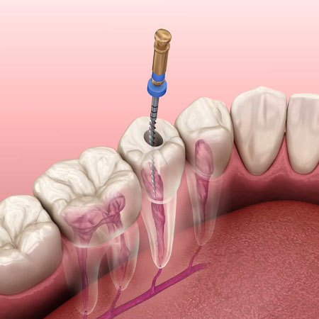 Painless Root canal treatments in Guntur