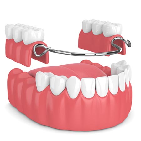 Partial and complete dentures in Guntur