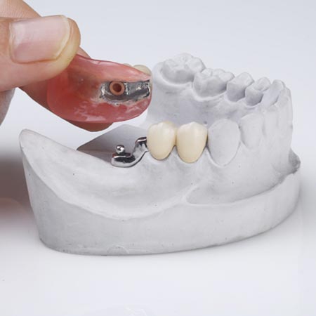 Precision attachment for partial dentures
