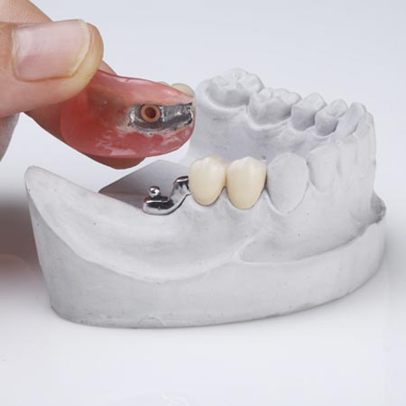 Precision attachment for partial dentures