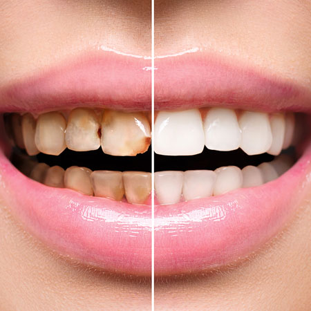 Scaling and Teeth whitening in Guntur